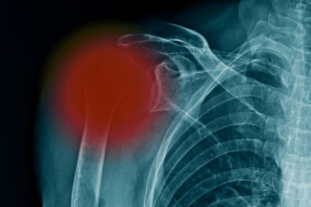 An x-ray of a shoulder injury